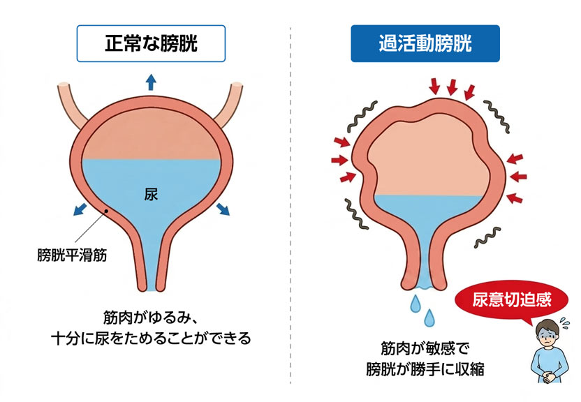 図：正常な膀胱と過活動膀胱
