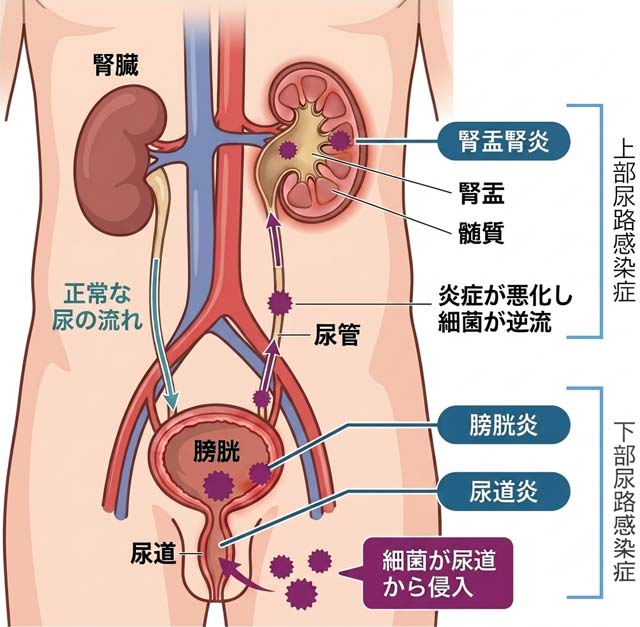 図：尿路感染症の種類