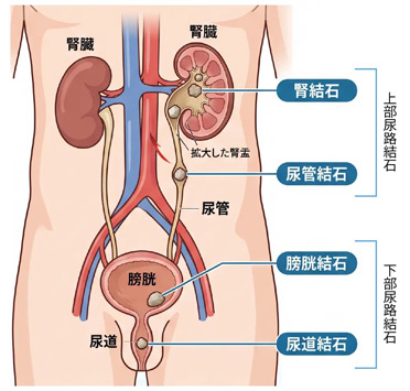 図：尿路結石の種類